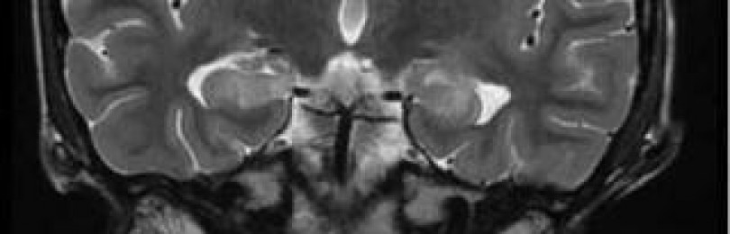 Магнитно-резонансная томография в диагностике наследственных лейкоэнцефалопатий (обзор литературы)